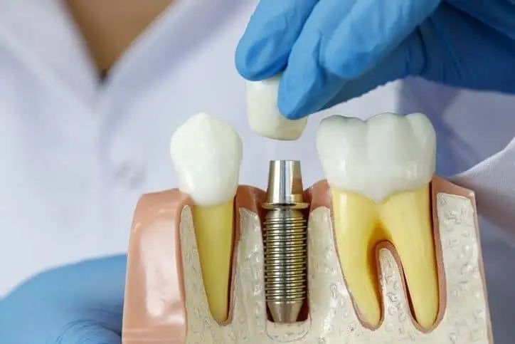 blogs Dental Implant