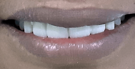 Dental Crown After
