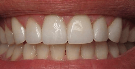 Dental Crown After