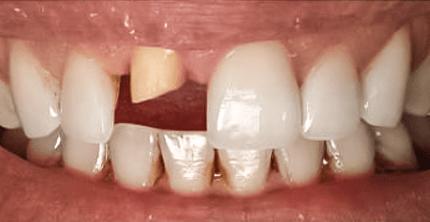 Dental Crown Before