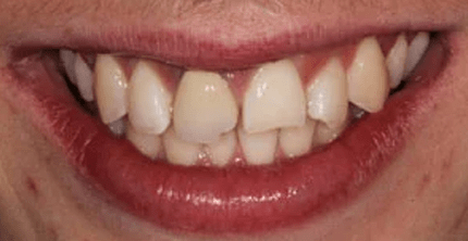 Dental Crown Before