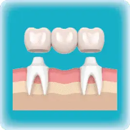 Dental bridges
