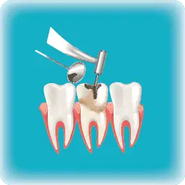 Dental Filling