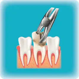 Tooth Removal