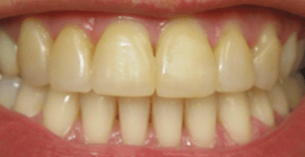 Whitening case-1 pic-1 