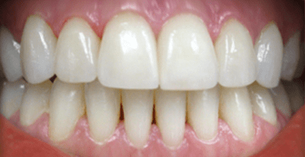 Whitening case-1 pic-2