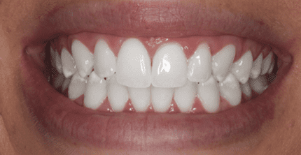 Whitening case-5 pic-2