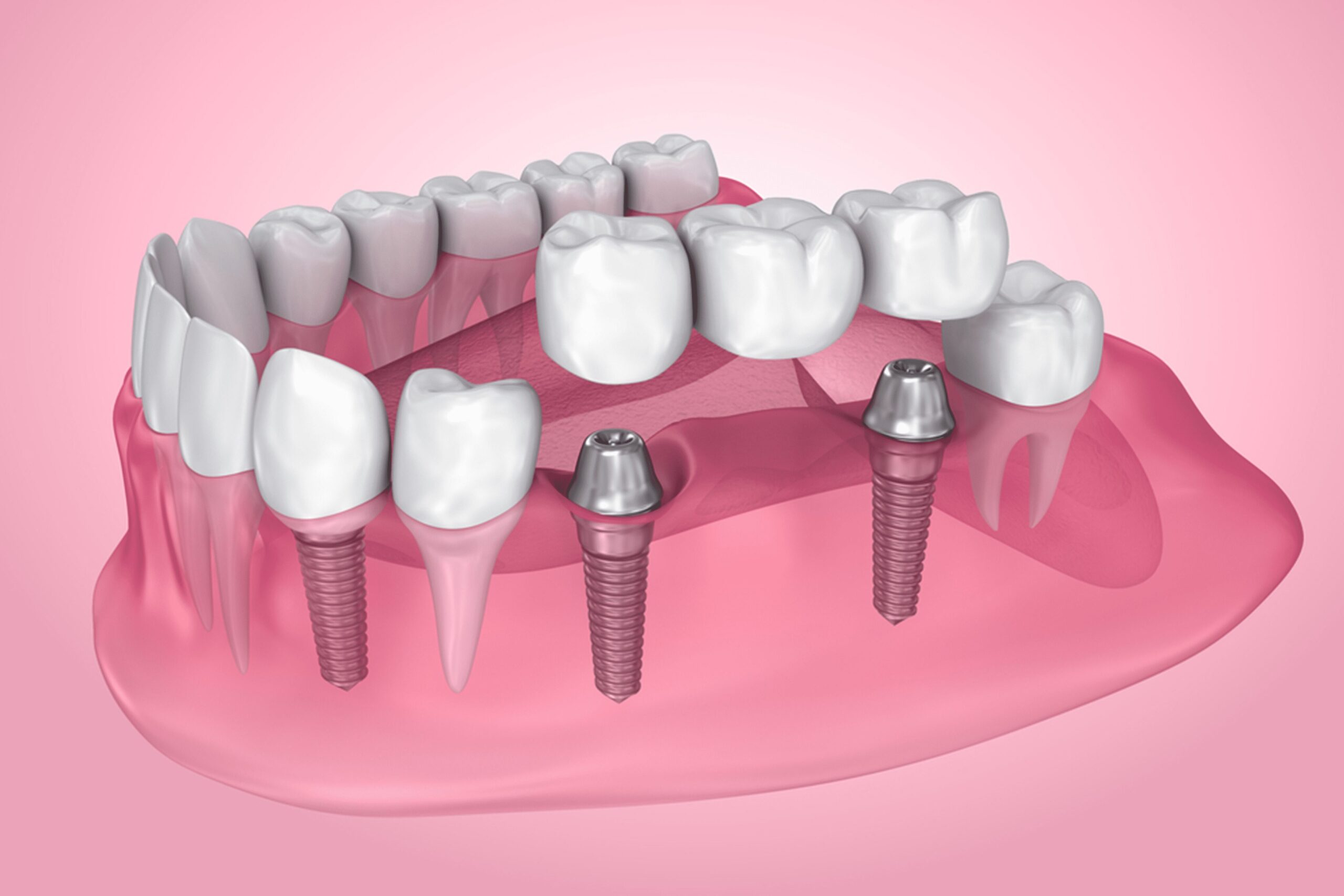 Dental Bridge