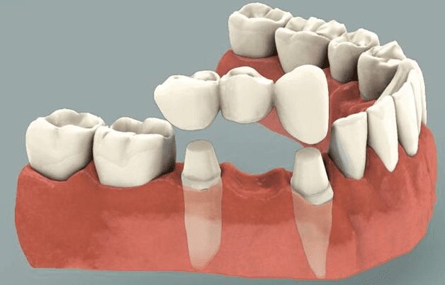fixed dental bridge