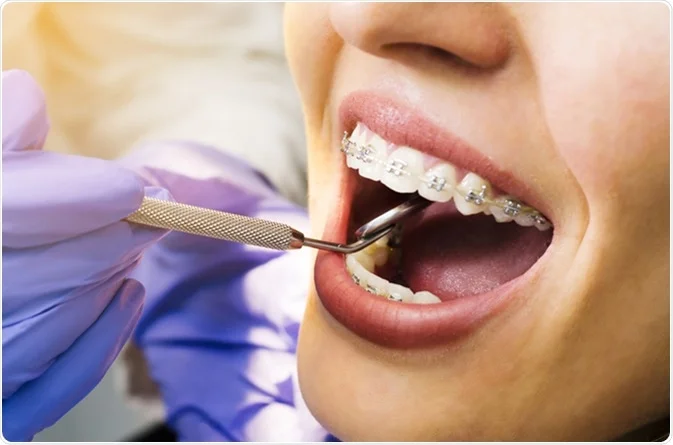 Braces in North Hollywood  Victory Plaza Dental Group