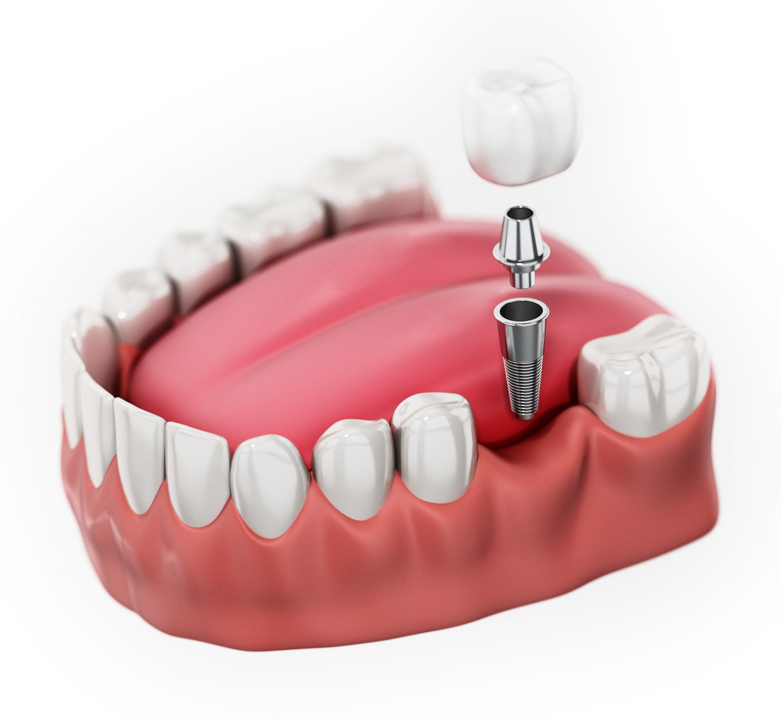 dental-implants