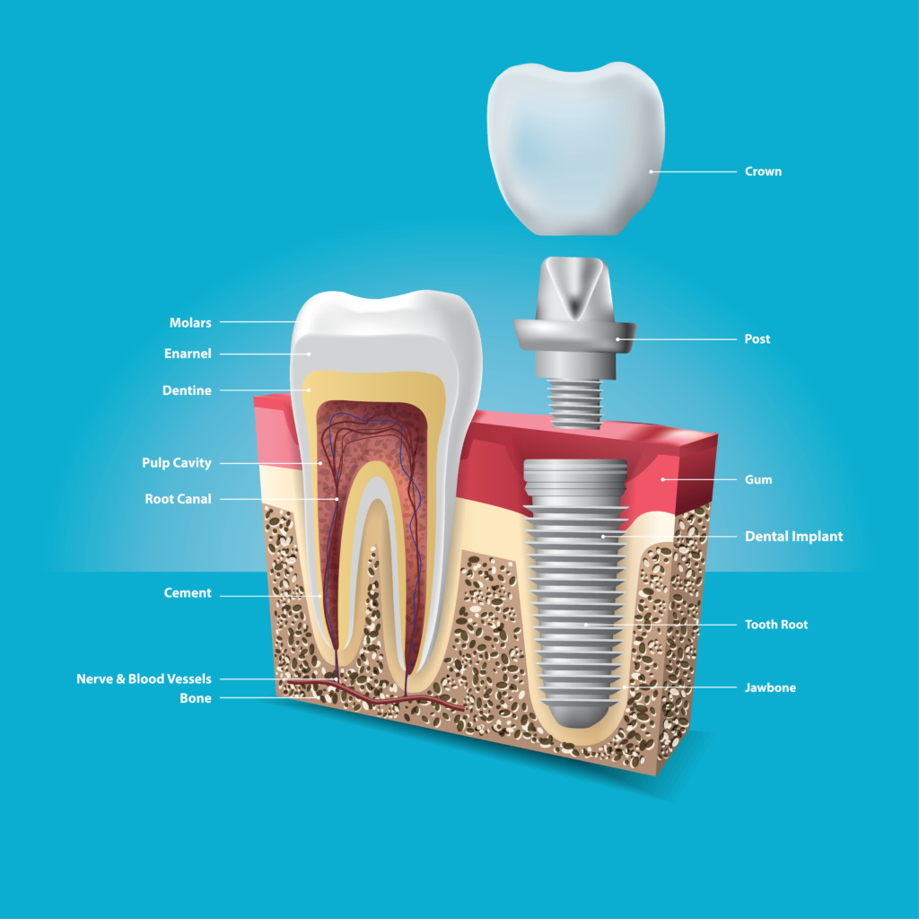 Dental Implant