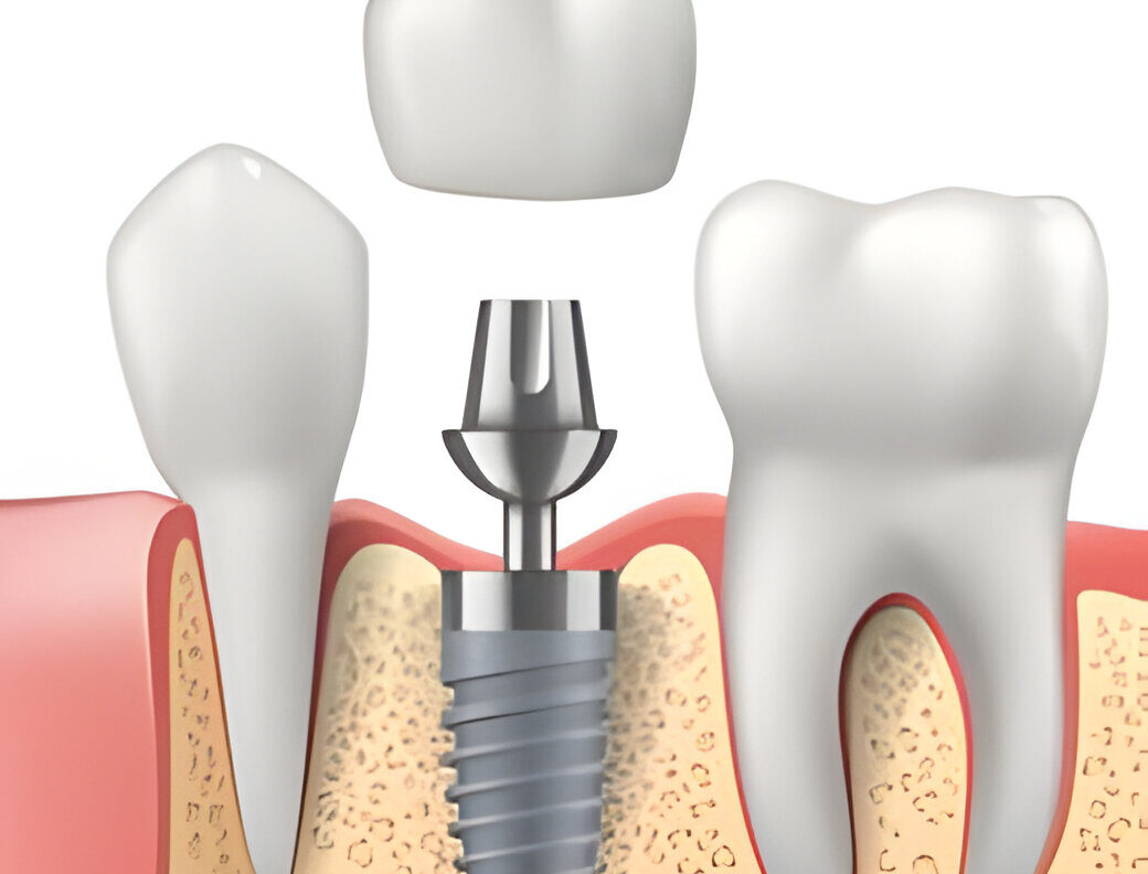 dental implants in dubai